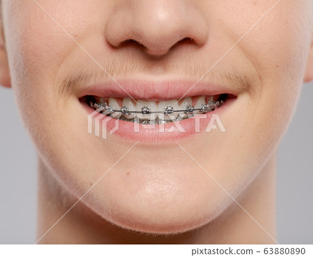 Teeth of a young man with braces on his teeth Teeth of a young man with braces on his teeth 63880890