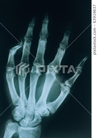 X-ray of the hand. A real x-ray of the human hand, fingers and bones. Finger injury 63919637