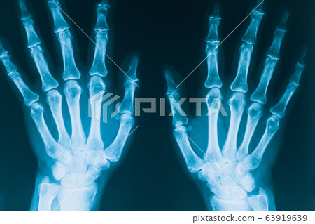 X-ray of hands. Real x-ray picture of hands, two hands in projection. Human bones. Medical concept. 63919639