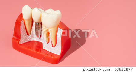 Example of Implants and dental tools. 63932977