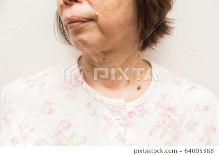 老年性懷孕疣 64005388