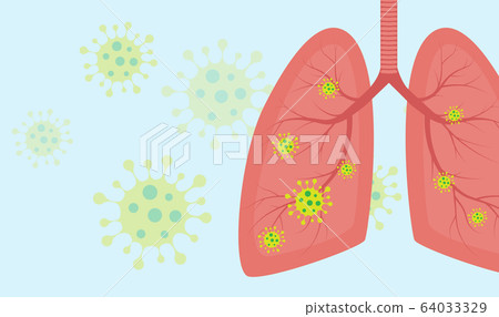 Virus cells in lung. Infected lungs. Coronavirus, COVID-19. 2019-nCoV. lung disease, pneumonia, asthma, cancer, tuberculosis. 64033329