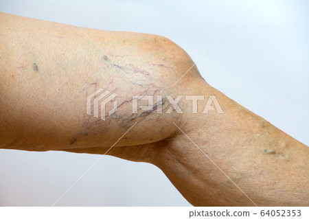 Varicose veins on a leg in Senior women in white background, Close up & Macro shot, Asian body skin part, Healthcare concept 64052353