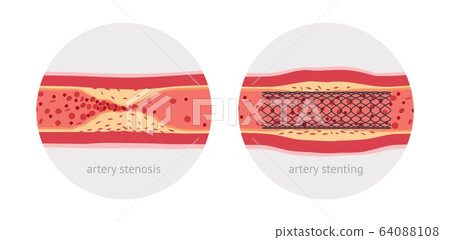 Stenting sick human artery, before and after, flat design illustration 64088108