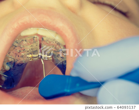 Children mouth with white blue teeth braces Children mouth with white blue teeth braces 64093137
