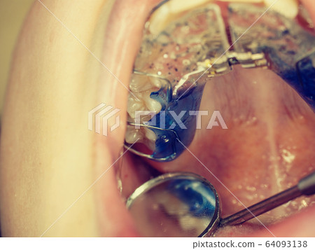 Teenager with braces on his teeth. Macro shot Teenager with braces on his teeth. Macro shot 64093138
