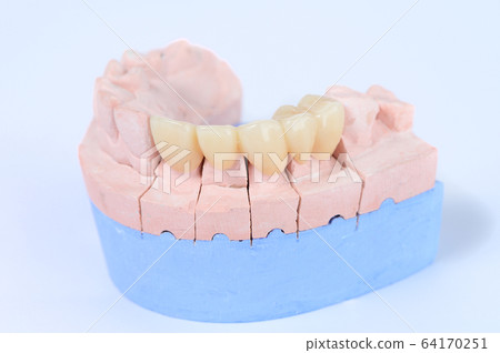 Ceramic tooth crown on plaster model Ceramic tooth crown on plaster model 64170251