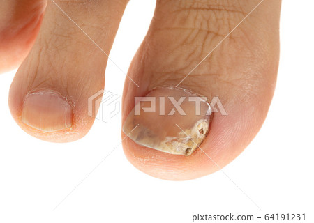 Nail athlete's foot 64191231