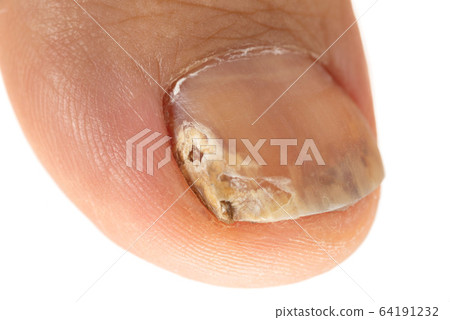 Nail athlete's foot 64191232