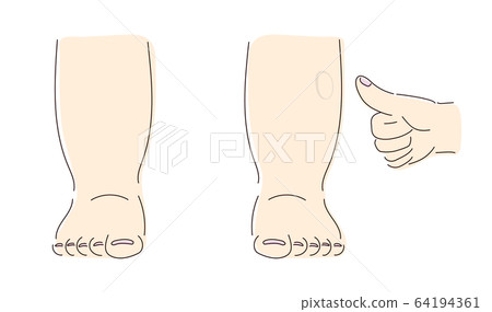 Swelling of the legs 64194361