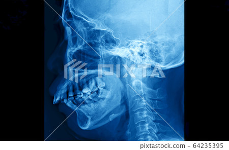 Film x-ray skull and cervical spine lateral view 64235395
