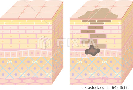 皮膚的3D剖面圖。健康和沾染皮膚。 皮膚的3D剖面圖。健康和沾染皮膚。 64236333