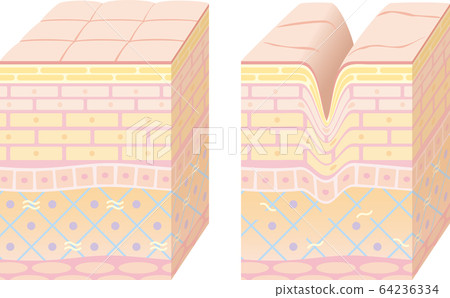 皮膚的3D剖面圖。健康的皮膚和皺紋的皮膚。 64236334