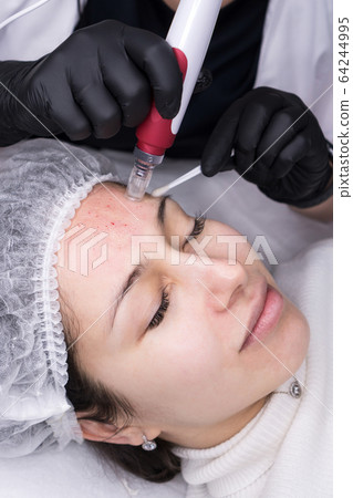 Micro needle mesotherapy. Derma pen 64244995