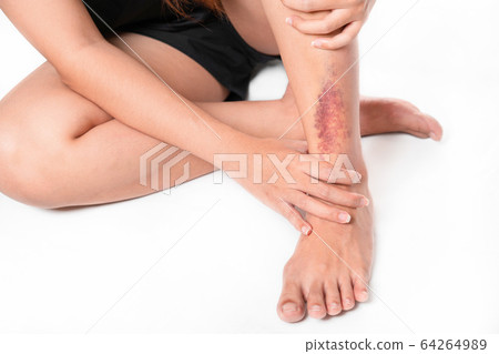 Asian women have bruise on leg from accident on 64264989