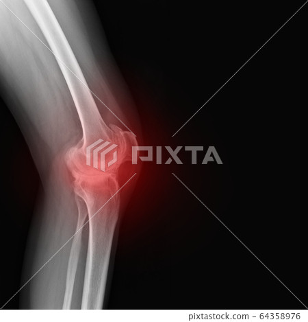 Real skeleton x-ray of woman knee suffering from rheumatism. Rheumatoid arthritis knee pain medical concept, medical diagnostics, traumatology and orthopedics 64358976