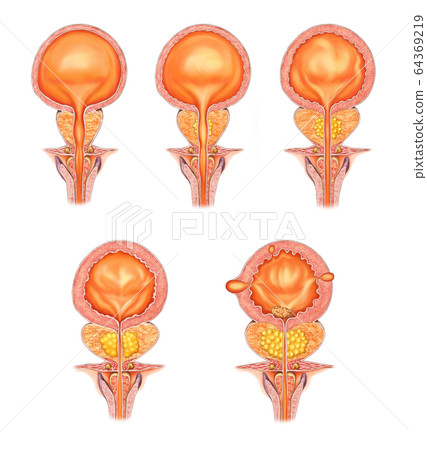 Anatomy of the prostate disease Anatomy of the prostate disease 64369219
