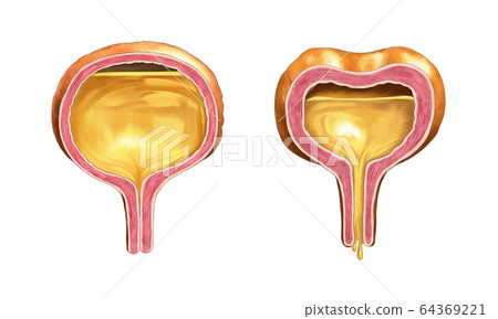膀胱易怒性膀胱解剖 64369221