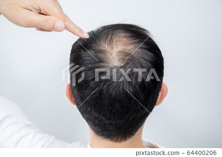 Middle aged man suffering thin hair 64400206