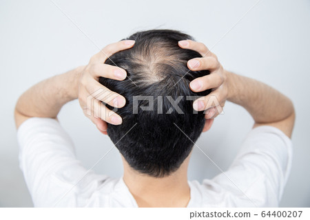 中年男子遭受稀薄的頭髮 64400207