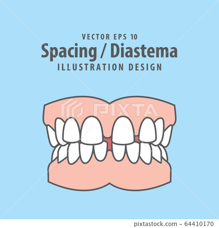 Dental spacing or diastema teeth illustration Dental spacing or diastema teeth illustration 64410170