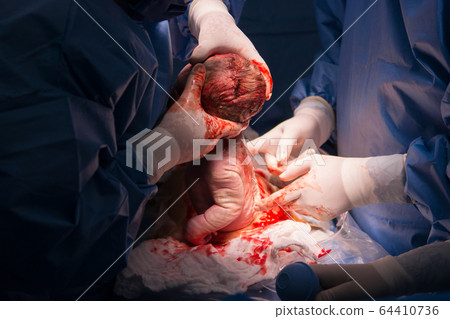 Cesarean section the operation is in process. 64410736
