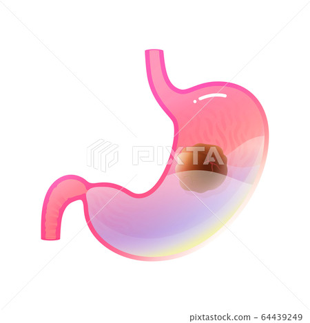Vector isolated illustration of stomach cancer Vector isolated illustration of stomach cancer 64439249