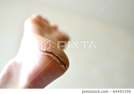 Dry cracked heel and callus on the foot. Monitor feet skin condition to prevent skin breakdown Dry cracked heel and callus on the foot. Monitor feet skin condition to prevent skin breakdown 64493198