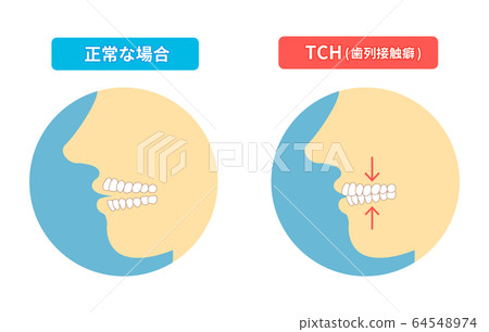 Teeth wear and TCH stress temporomandibular disorders Teeth wear and TCH stress temporomandibular disorders 64548974