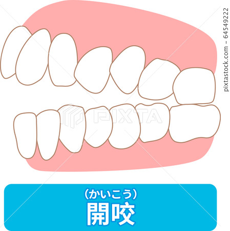 List of dentitions that require treatment: crowding, opposite occlusion, open bite, maxillary anterior protrusion, cavities, dentition 64549222