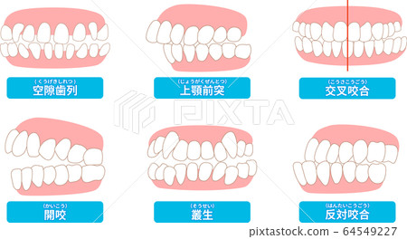 需要治療的牙列清單:擁擠,對側咬合,咬合,上頜前突,蛀牙,牙列 需要治療的牙列清單:擁擠,對側咬合,咬合,上頜前突,蛀牙,牙列 64549227