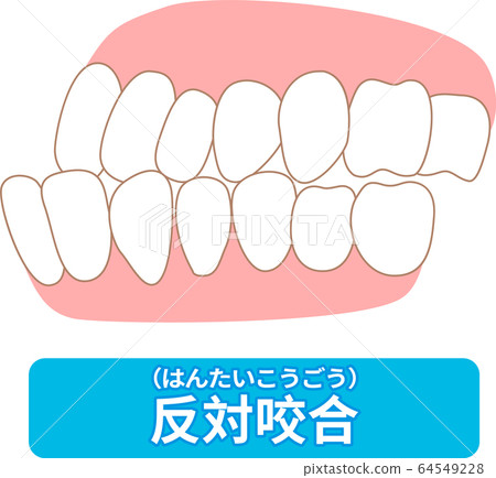 List of dentitions that require treatment: crowding, opposite occlusion, open bite, maxillary anterior protrusion, cavities, dentition List of dentitions that require treatment: crowding, opposite occlusion, open bite, maxillary anterior protrusion, cavities, dentition 64549228