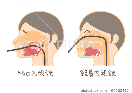 口腔內窺鏡和經鼻內窺鏡的插圖（插入胃鏡和文本） 64582412
