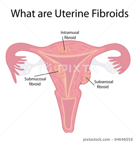 Types of Uterine Fibroids 64646058