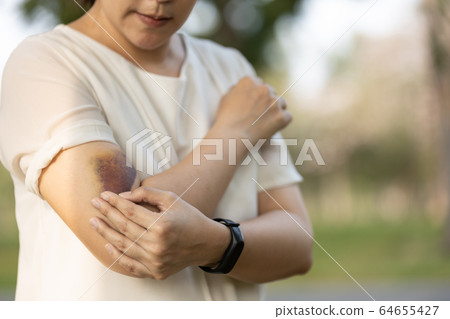 Sad asian female people showing a bruise in her arm,woman has bruises all over her body,caused by the abuse of a family or her husband violently attacked,being hit by a hard,bashing causes bruising Sad asian female people showing a bruise in her arm,woman has bruises all over her body,caused by the abuse of a family or her husband violently attacked,being hit by a hard,bashing causes bruising 64655427
