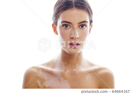 beautiful young brunette woman with vitiligo disease isolated on white positive smiling, model problems concept, bad tan real problem 64664167