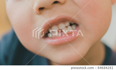 乳牙 問世 兒童 64684281