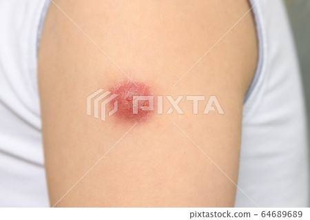 Hand of a kid with a reaction to the BCG vaccine Hand of a kid with a reaction to the BCG vaccine 64689689