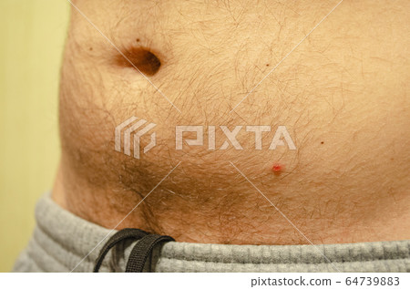 Chickenpox. Acne on the skin of a man. Close-up. Chickenpox. Acne on the skin of a man. Close-up. 64739883
