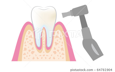 牙醫牙科PMTC程序的插圖dental_pmtc_step07 64781904