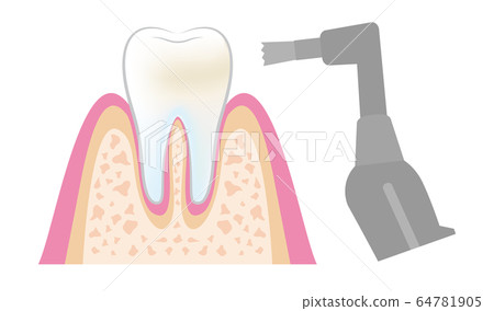 Illustration of dentist Dental PMTC procedure dental_pmtc_step05 64781905