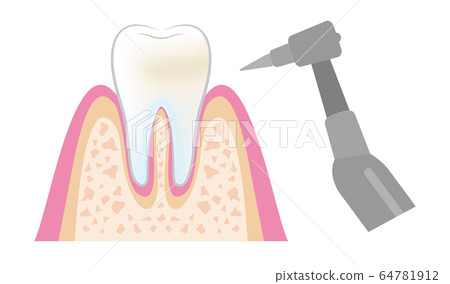牙醫牙科PMTC程序的插圖dental_pmtc_step06 64781912