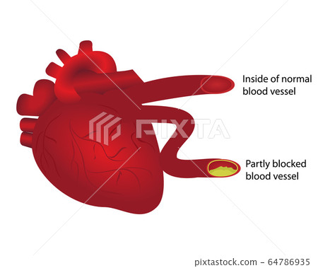 Heart with normal and partly blocked blood vessel 64786935