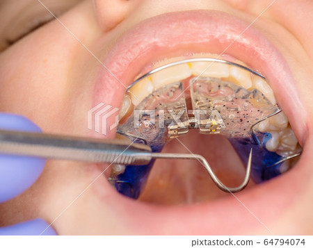 Children mouth with white blue teeth braces Children mouth with white blue teeth braces 64794074