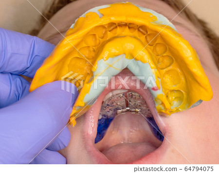 Dentist use dental impression for check braces Dentist use dental impression for check braces 64794075