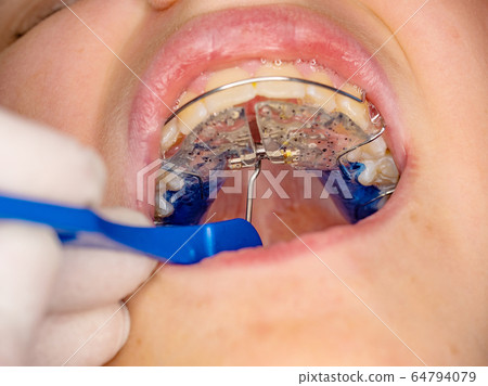 Doctor set with tool of Hyrax Expander RPE, Especial palatal braces for correction of birth defect. 64794079