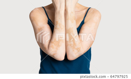 Cropped of woman with skin condition loss of melanin Cropped of woman with skin condition loss of melanin 64797925