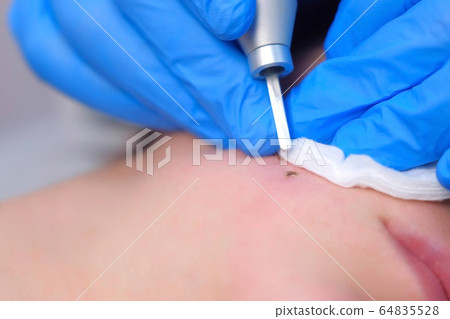 Process of removing mole using laser on woman's face by surgeon, burning skin. 64835528