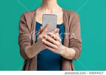 Bodipozitiv. Woman with vitiligo makes selfie, cropped Bodipozitiv. Woman with vitiligo makes selfie, cropped 64844427