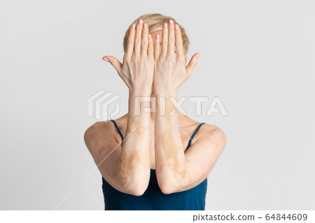 Woman with pale vitiligo spots covers her face 64844609